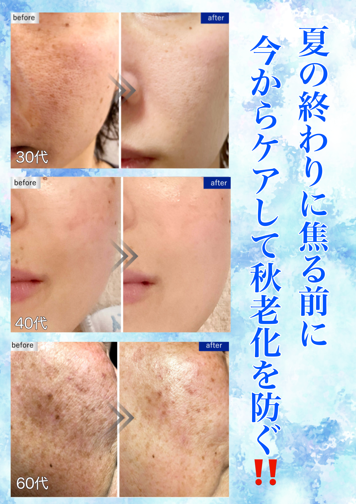 広島エステ　シミ取りエステ